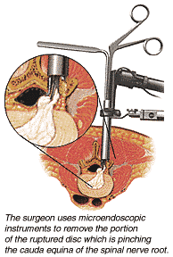 LOWER TREATMENT